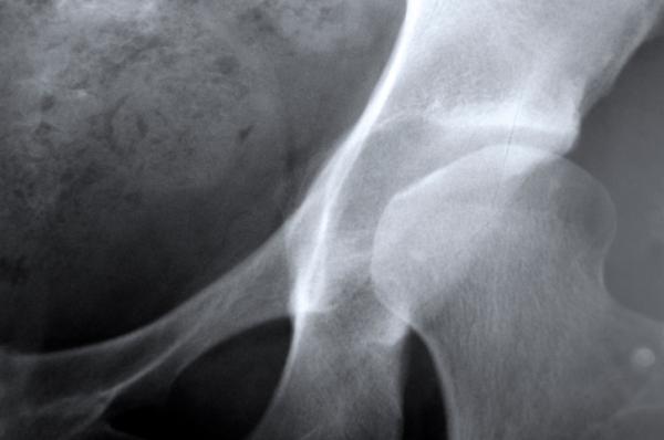 Fra 10 anni in Europa 34 milioni di donne con l&#8217;osteoporosi