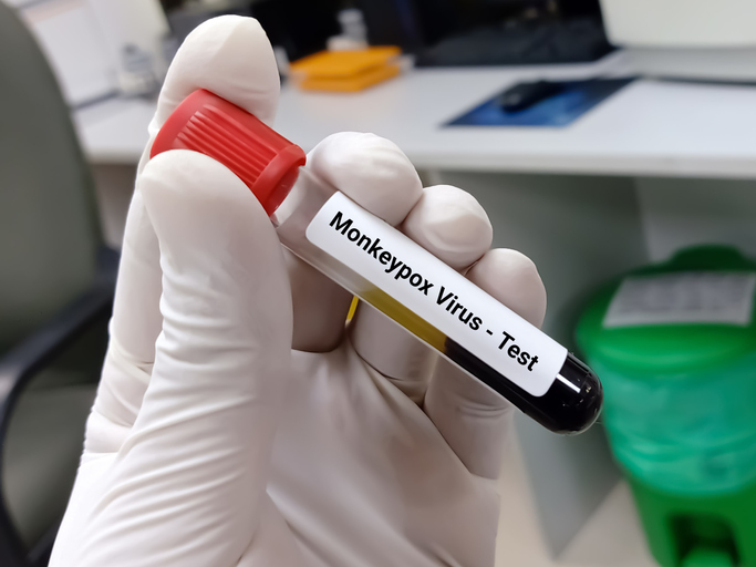 Monkeypox: casi, sintomi, contagi ed evoluzione