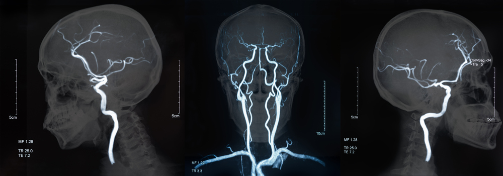 Ictus: l&#8217;importanza della prevenzione e delle Stroke Unit