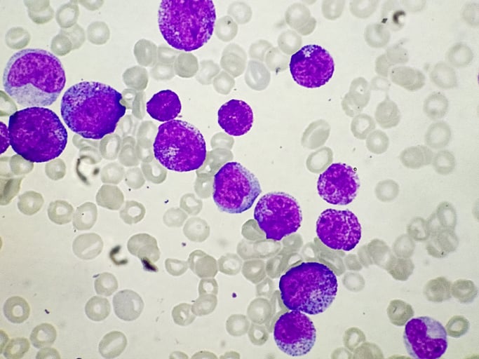 Leucemia mieloide cronica: cure sempre più efficaci
