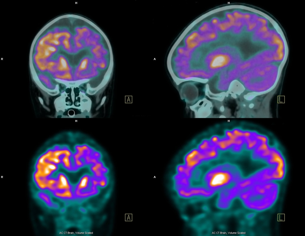 Così l&#8217;epilessia diventa cronica
