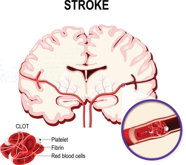 I cinque campanelli d’allarme dell’ictus cerebrale