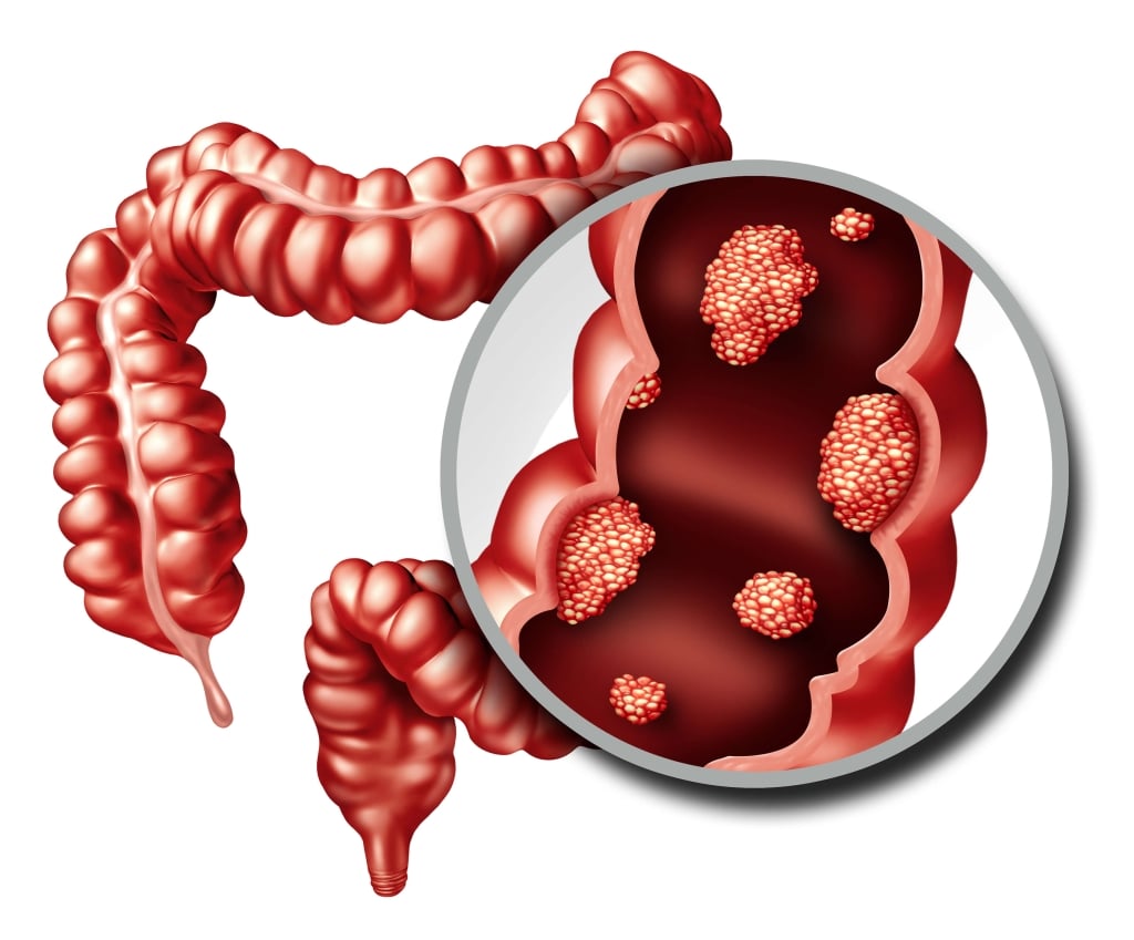 Un polipo intestinale su quattro sfugge alla colonscopia