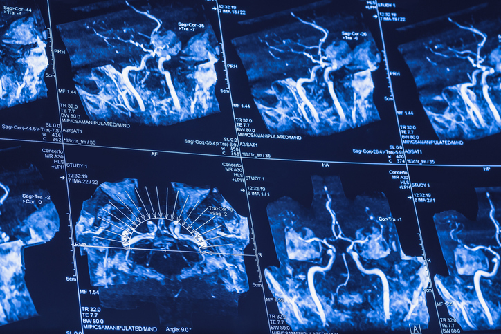 Ictus: recupero migliore se il cervello viene messo a «riposo»