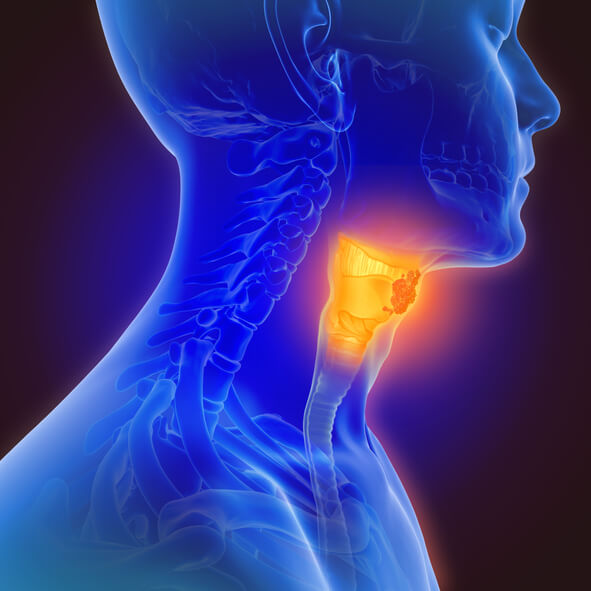 Come il cancro della tiroide si trasforma in malattia cronica
