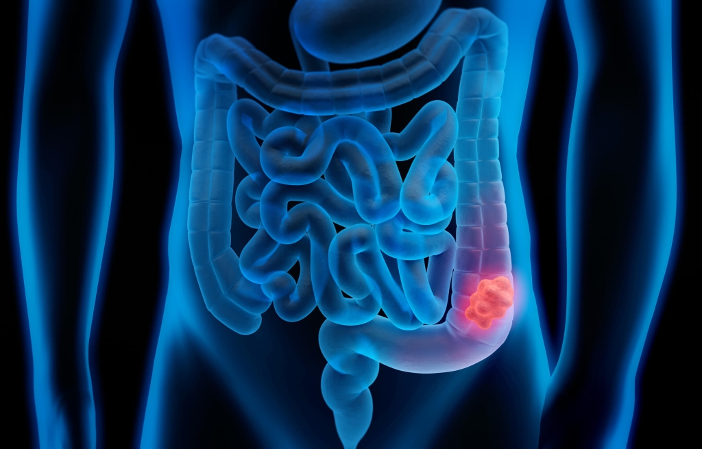 Così le cellule dei tumori del colon si fanno scudo con gli zuccheri