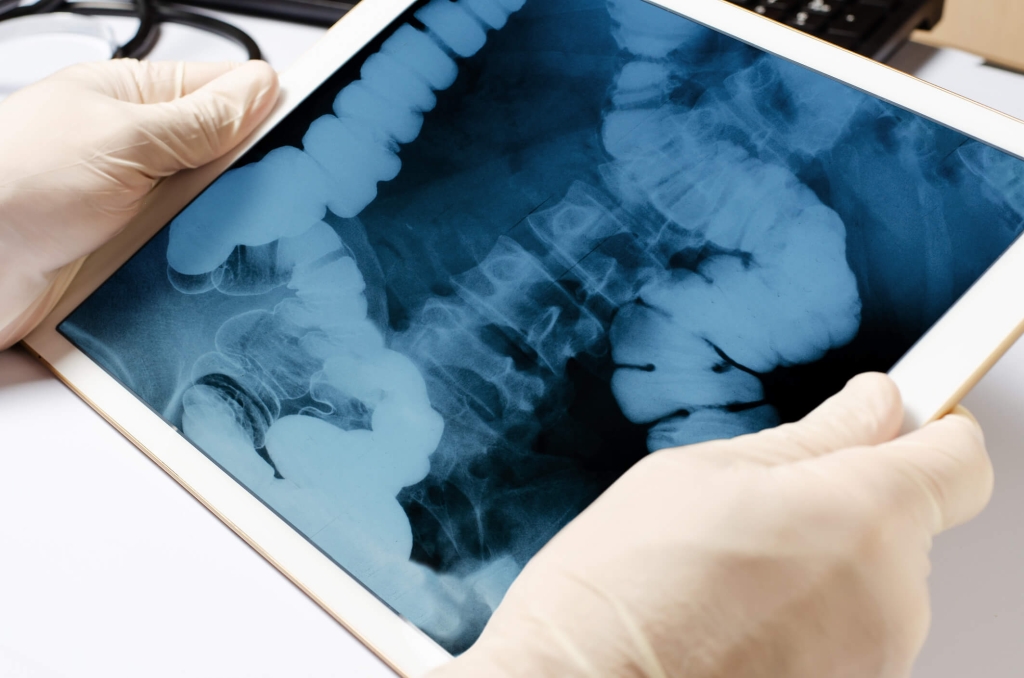 Fra gli effetti del Covid-19, tumori del colon più difficili da curare