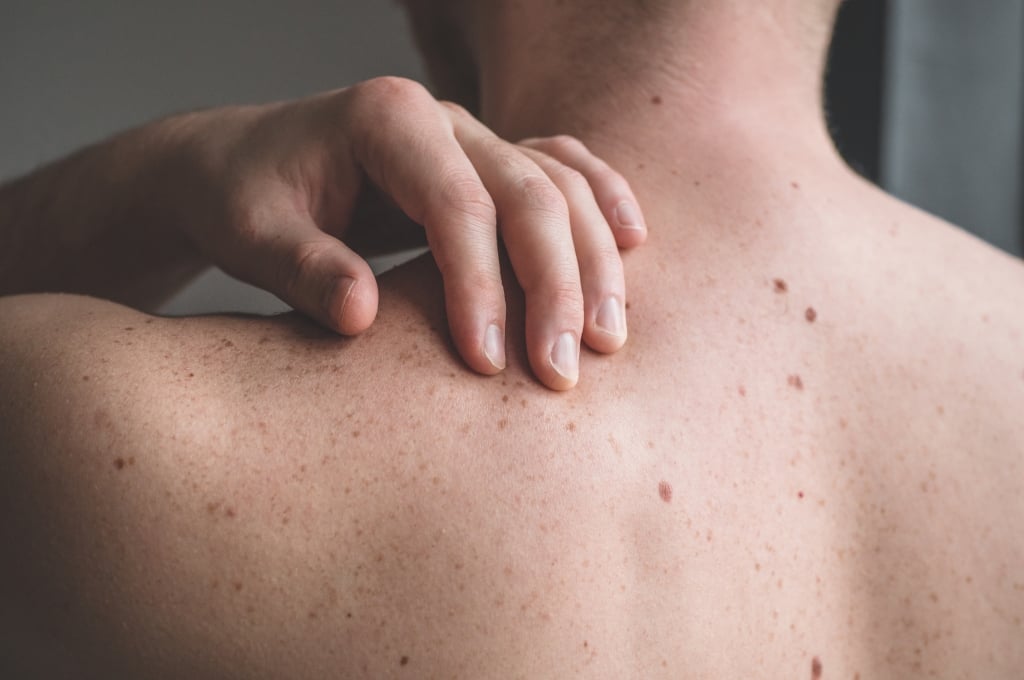 Controllo dei nei e prevenzione del melanoma: falsi miti comuni