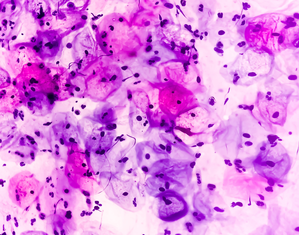 Biopsia Cervicale