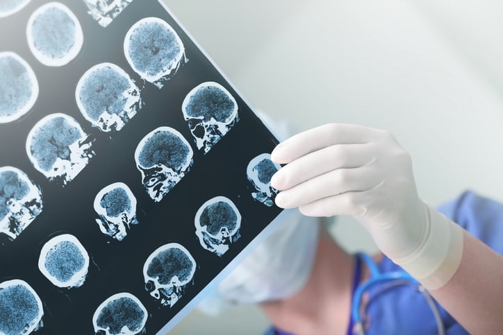 Da dove origina l&#8217;Alzheimer?