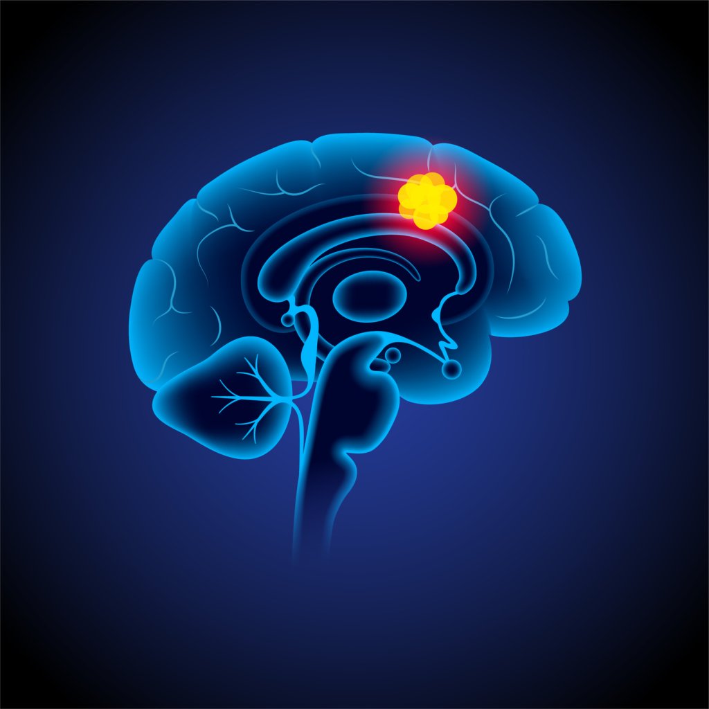 Glioma