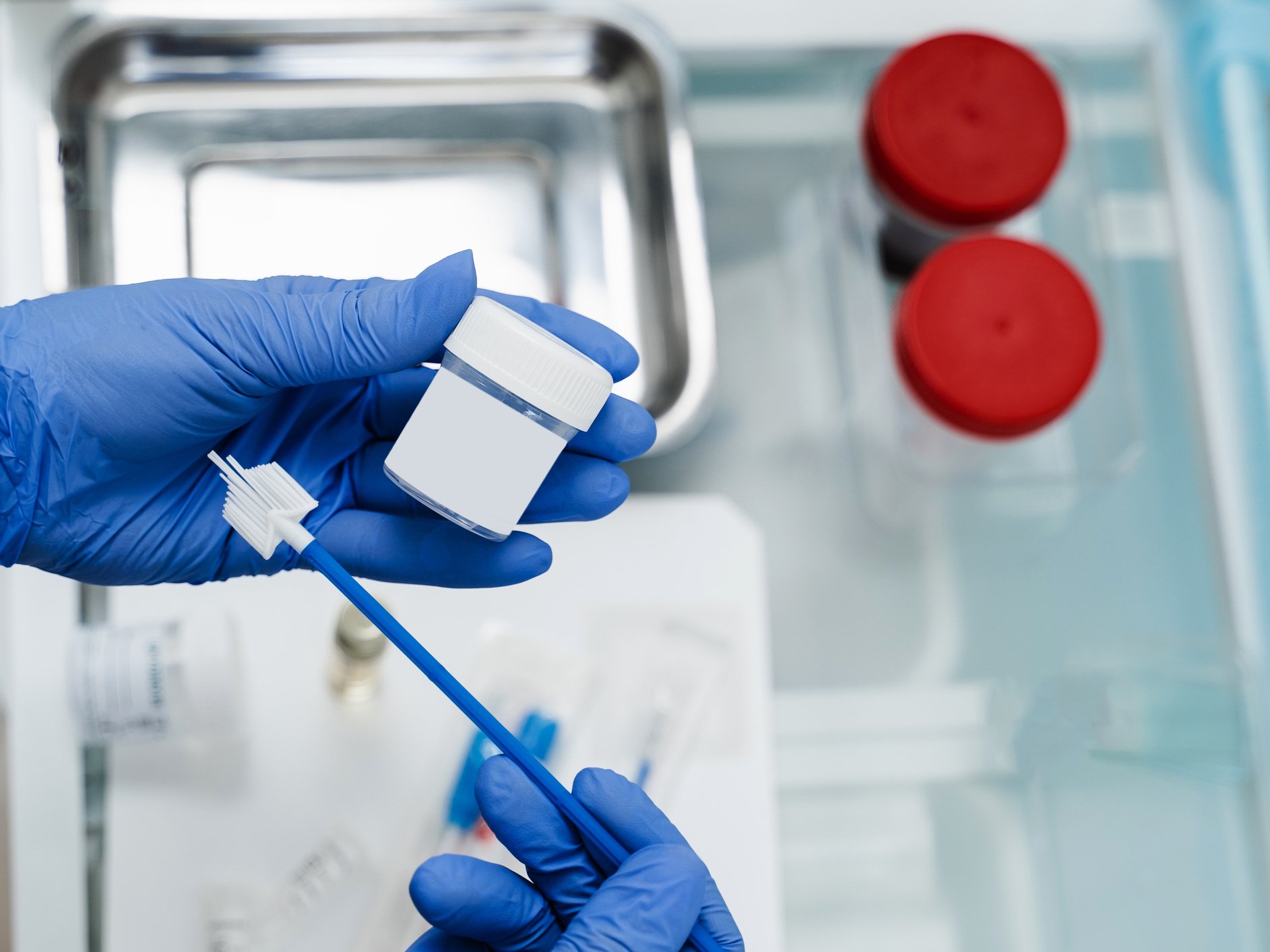 Kit per la raccolta del campione per Pap test o HPV test, utilizzato nella prevenzione del tumore del collo dell’utero