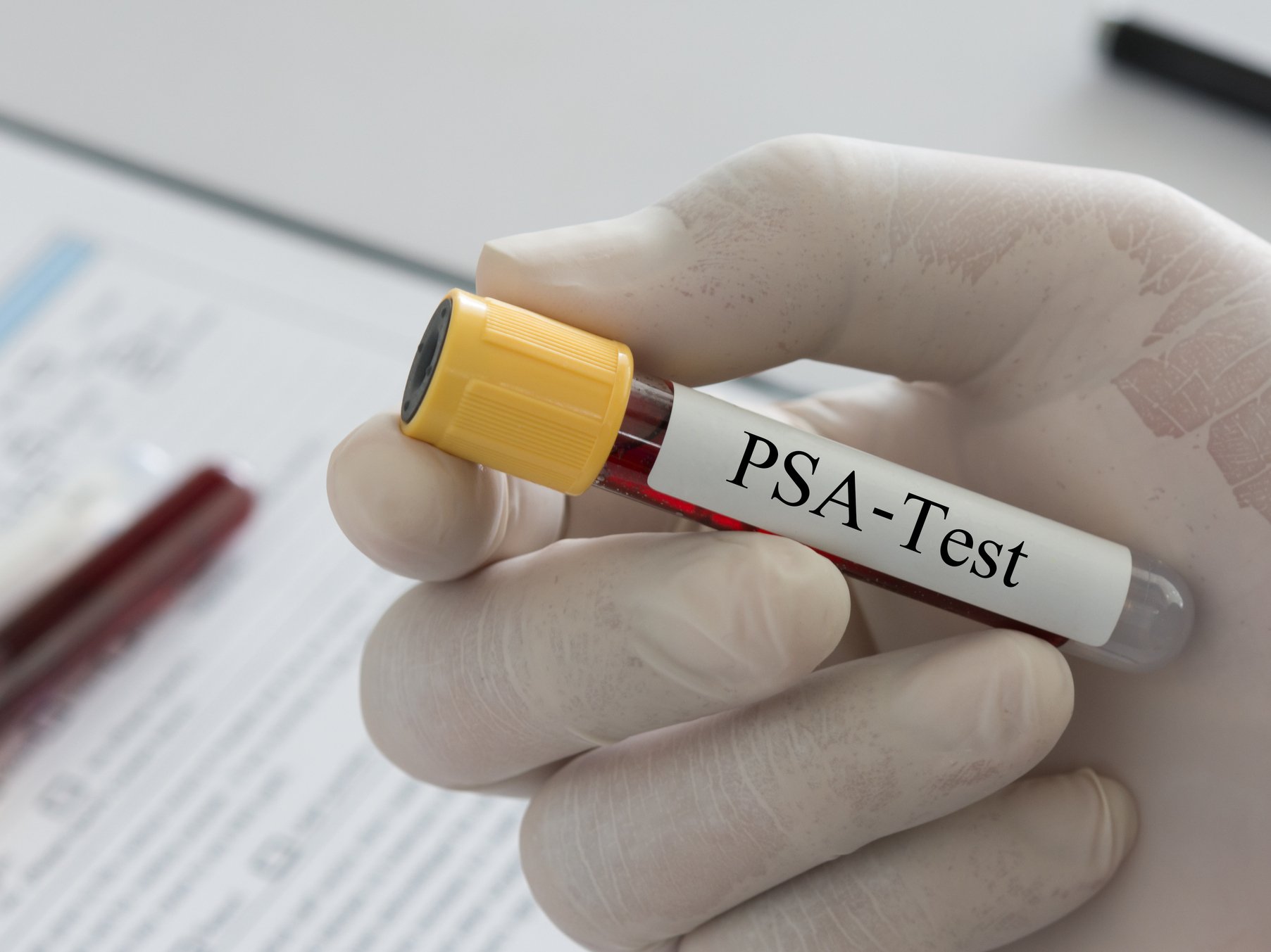 Mano guantata tiene una provetta per l’analisi del PSA, esame utilizzato nella diagnosi precoce del tumore prostatico.