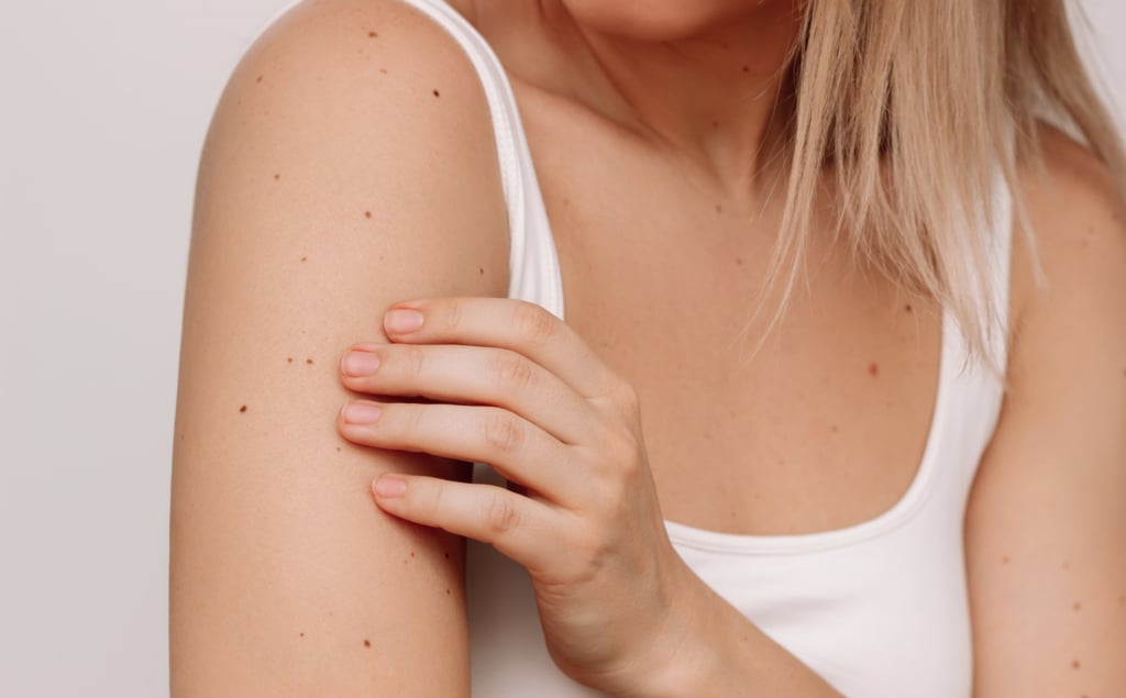 Esempi visivi di nei con asimmetria, bordi irregolari, colore variegato, diametro e evoluzione