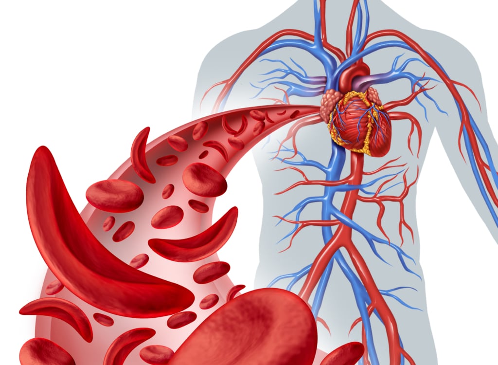 Leucemia linfatica cronica