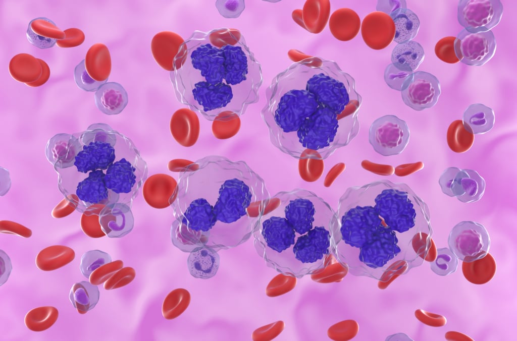 cellule di un linfoma pediatrico