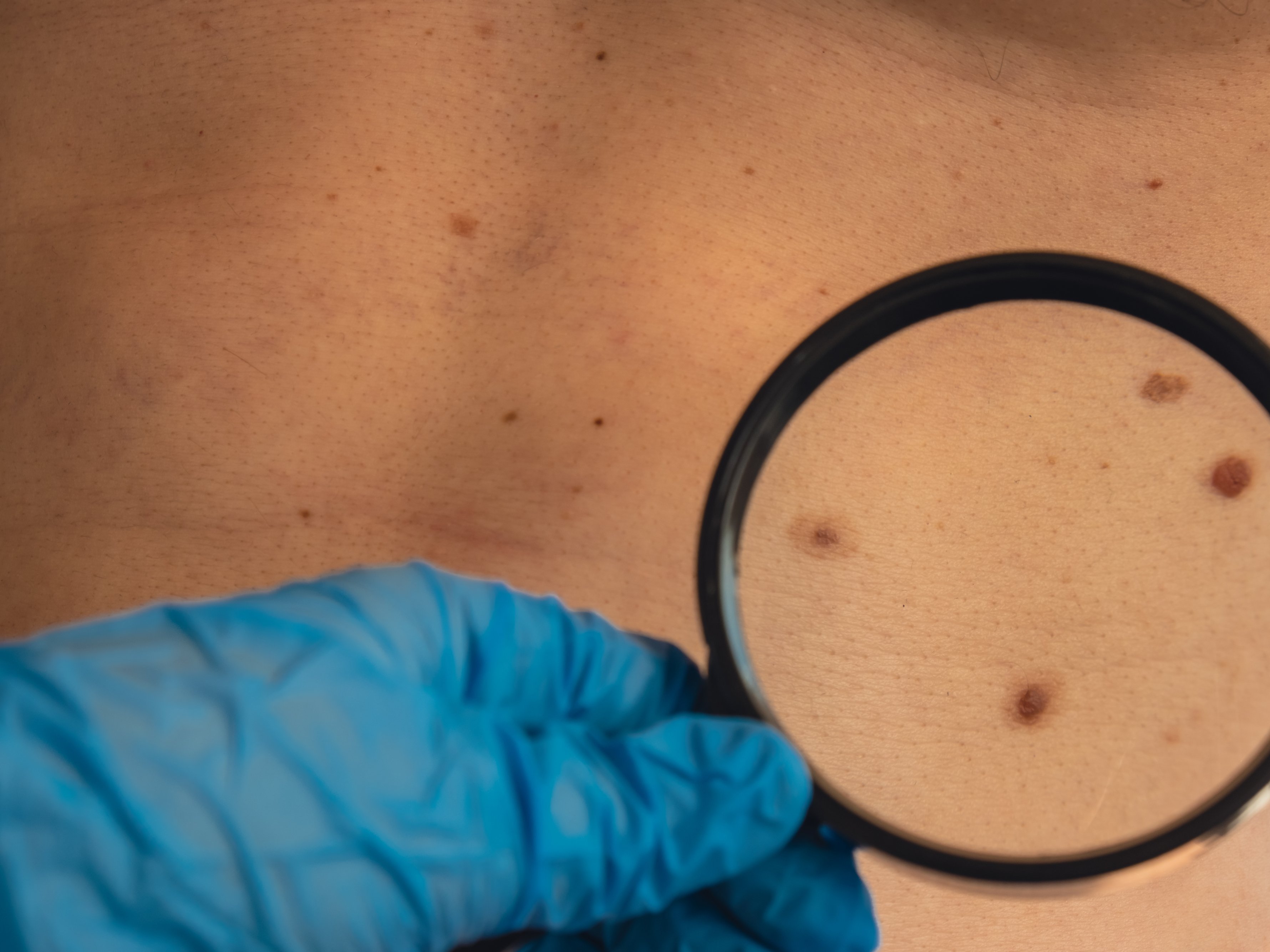 Che cosa è il melanoma