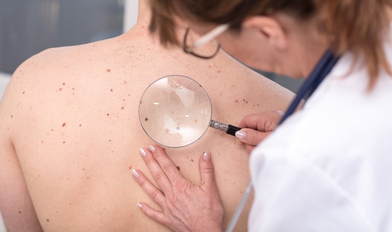 Controllo nei per sospetto melanoma