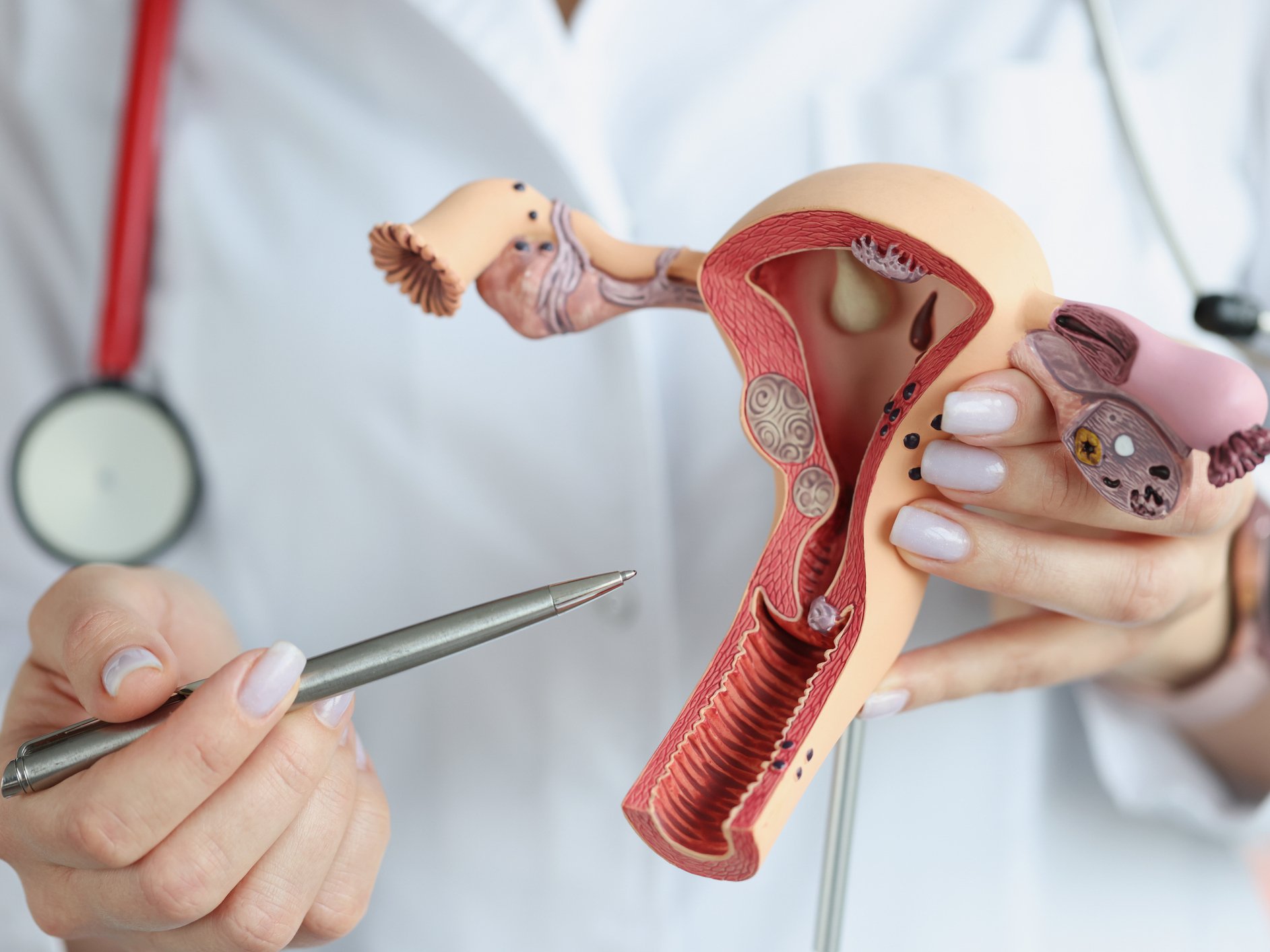 Cosa è il tumore dell'utero