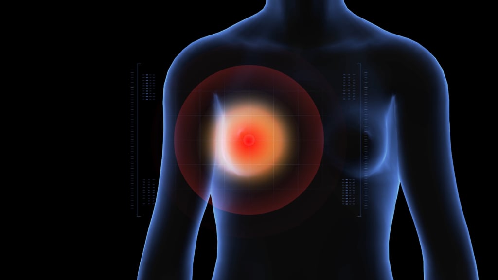 Tumore al seno triplo negativo