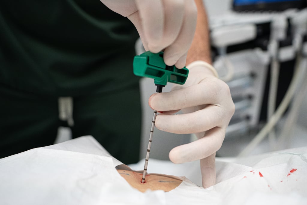 Procedura di prelievo di midollo osseo per poi effettuare il trapianto di midollo